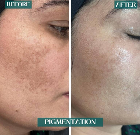 Original side-by-side pigmentation treatment photographs