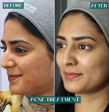 Acne treatment: original before photograph on the left and after on the right